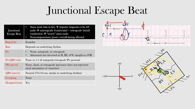 46.Junctional Escape Beat