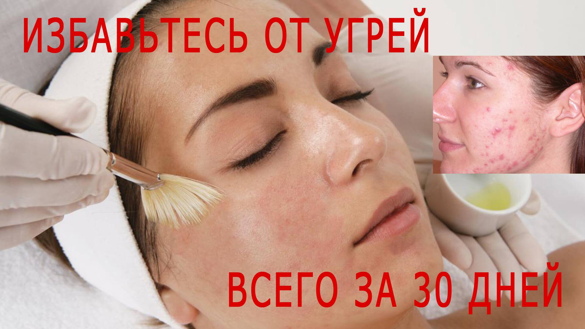 Как избавиться от угрей всего за 30 дней