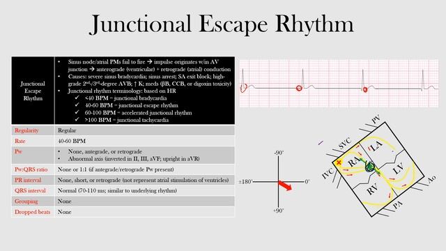 47.Junctional Escape Rhythm