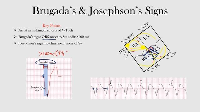 58.Brugada's & Josephson's Signs
