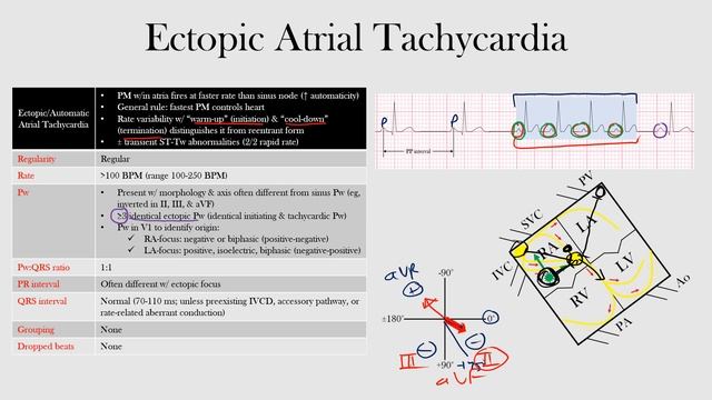 40.Ectopic Atrial Tachycardia