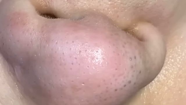Механическая чистка лица. Черные точки на носу