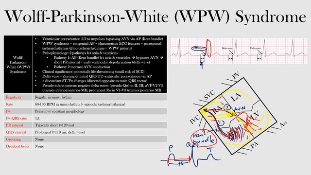 50.Wolff-Parkinson-White (WPW) Syndrome