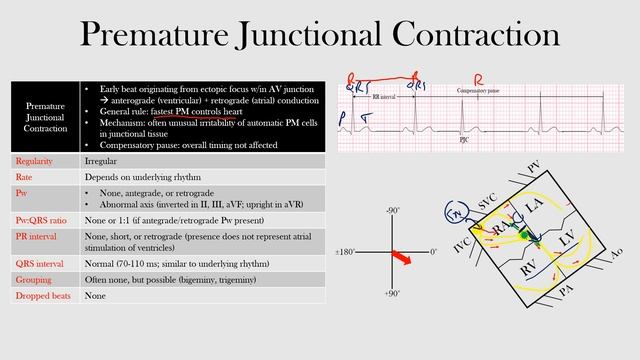 45.Premature Junctional Contraction