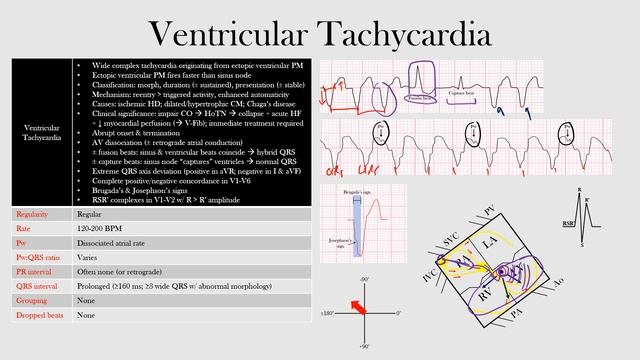 59.Ventricular Tachycardia