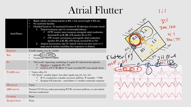 43.Atrial Flutter