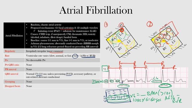 44.Atrial Fibrillation