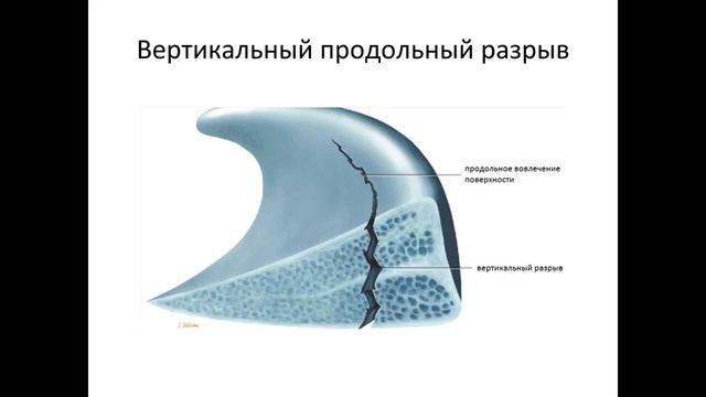 МРТ повреждения коленного сустава