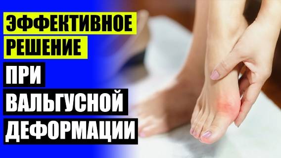 КАК ВЫРОВНЯТЬ ПАЛЬЦЫ НА НОГАХ У ВЗРОСЛОГО 🔔 СРЕДСТВО ОТ КОСТОЧКИ НА НОГЕ