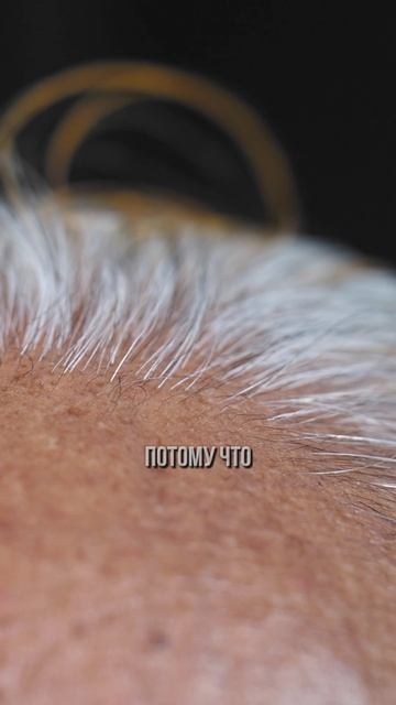 Пересадка волос #podcast #интервью