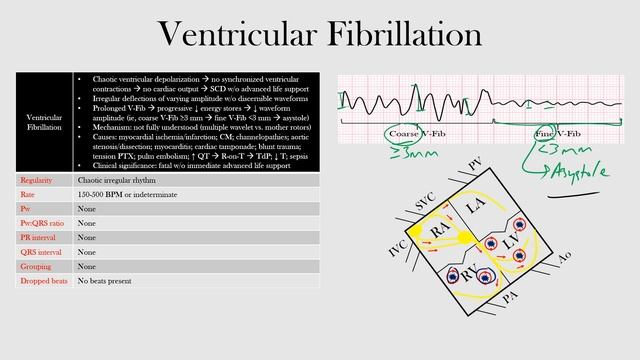 63.Ventricular Fibrillation