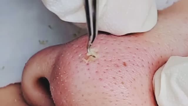 Механическая чистка лица. Нос в черных точках