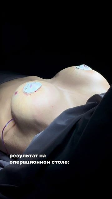 Увеличение груди - яркое до / после с результатом сразу на операционном столе