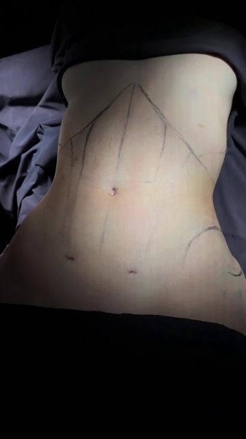 Пластика живота с липосакцией - результат сразу на операционном столе