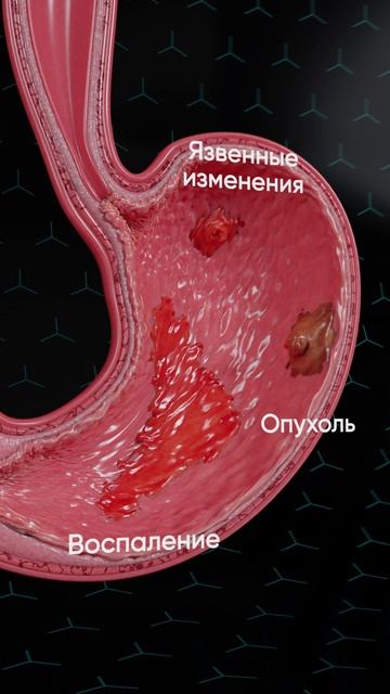 Гастроскопия. ФГДС. Диагностика во сне (под седацией)