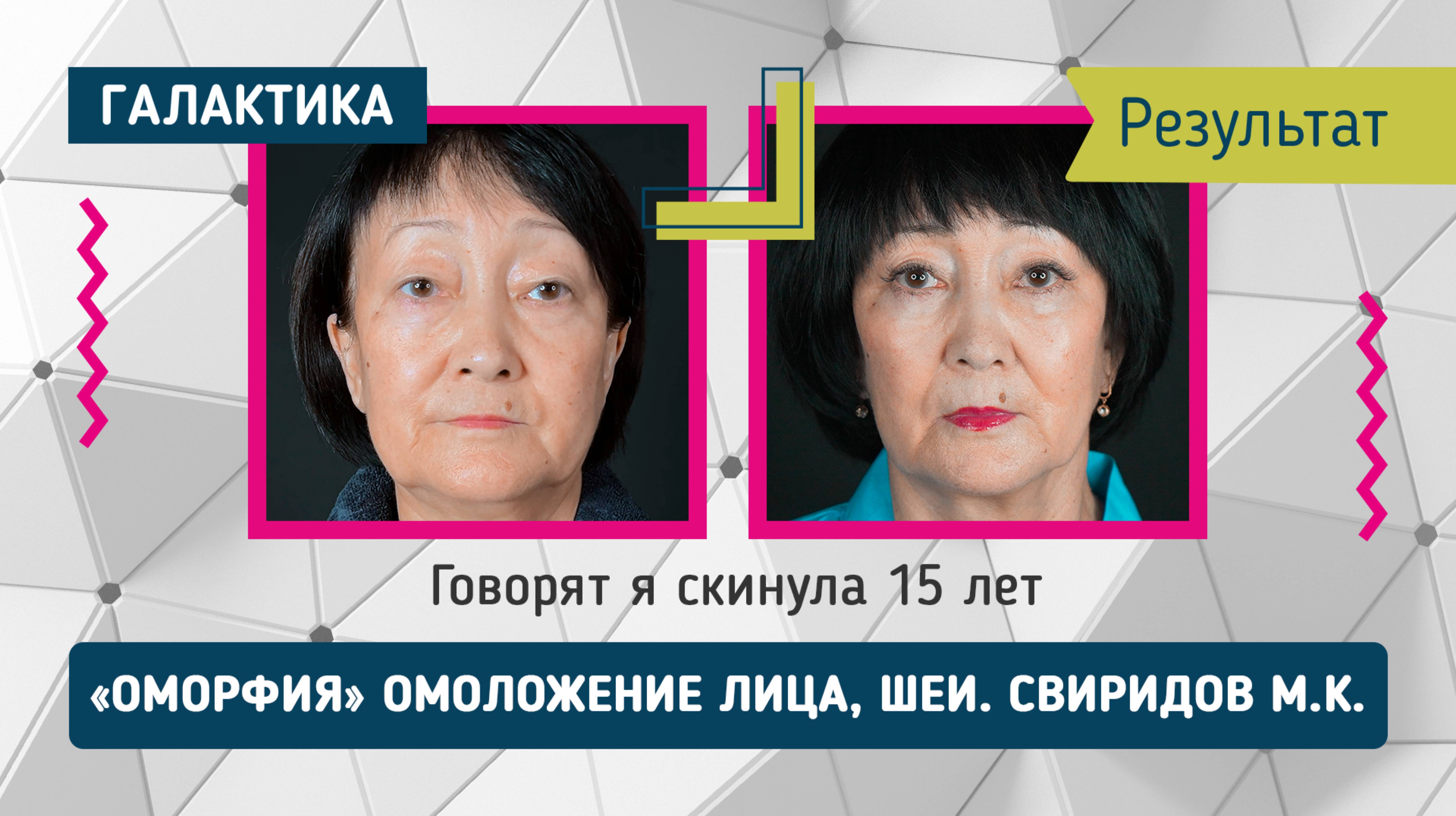 Проект "Оморфия" омоложение лица и шеи - результат | Свиридов Максим Константинович