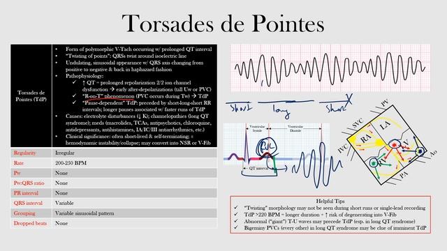 61.Torsades de Pointes