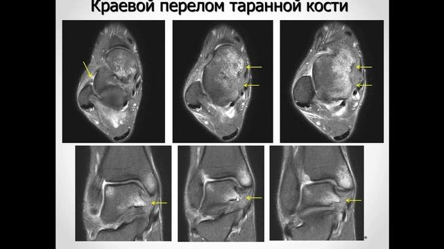 МРТ в диагностики основных повреждений голеностопного сустава