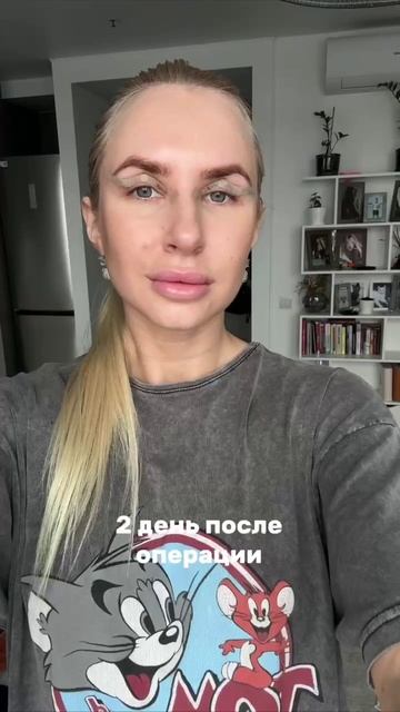 Результаты верхней блефаропластики - как выглядит пациентка до операции и после нее?