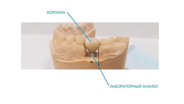 Лабораторные компоненты протезов на имплантах.