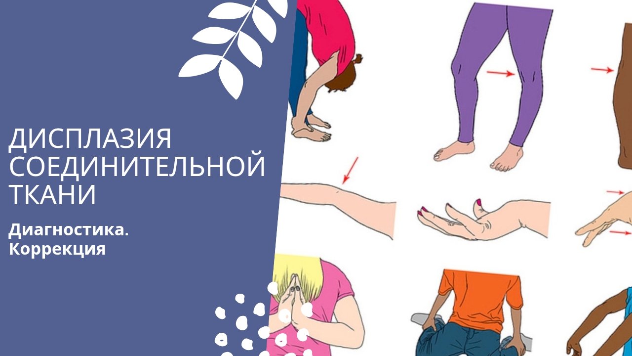 Дисплазия соединительной ткани