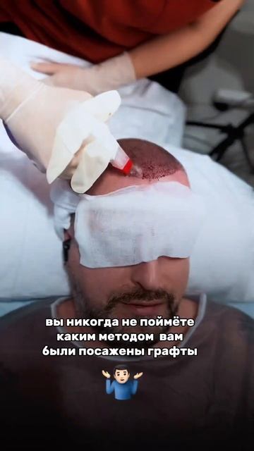 Обман в пересадке волос ✅ часть 1 #hairtransplant