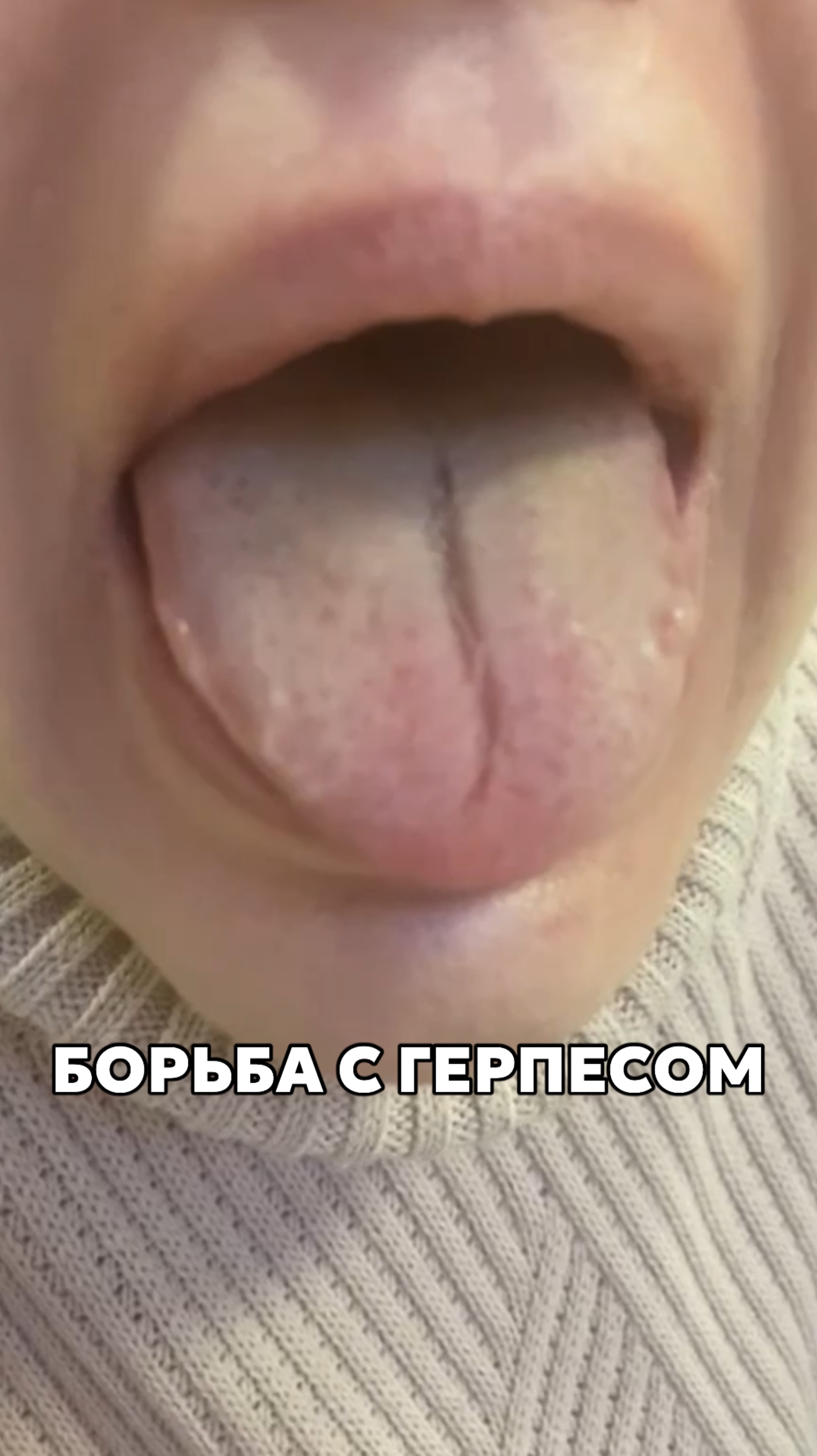Полностью вылечить герпес невозможно, так как вирус остается в организме пожизненно.