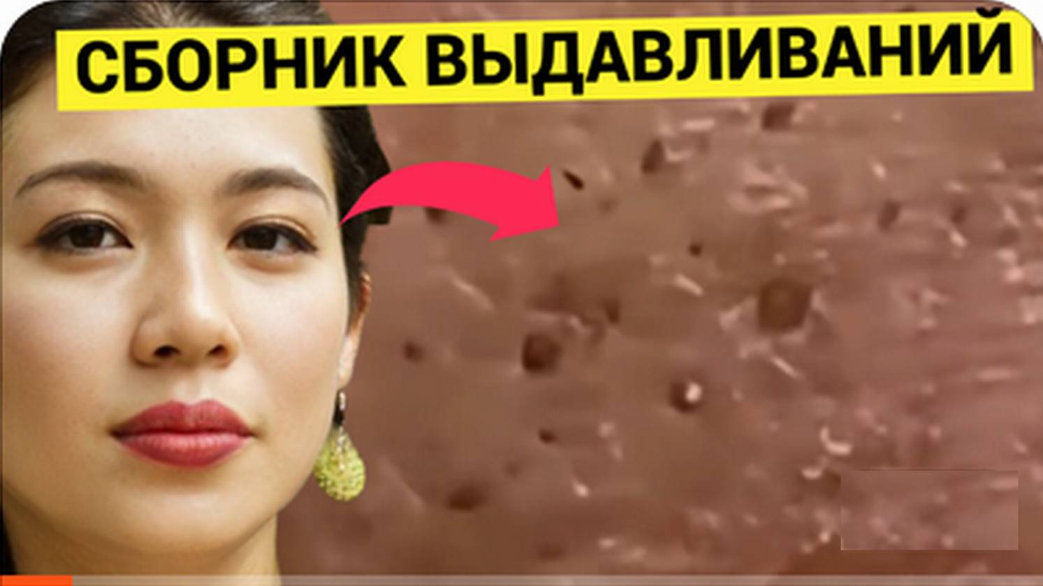 Короткий Микс-Релакс из ЛУЧШИХ Выдавливаний Прыщей и Жировиков. Максимально насыщенно в описании