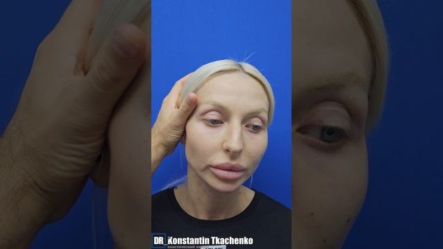 Эндоскопическая подтяжка лба и риносептопластика.
❗️В конце видео смотрите результат.