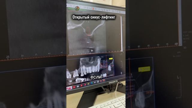Открытый синус-лифтинг
