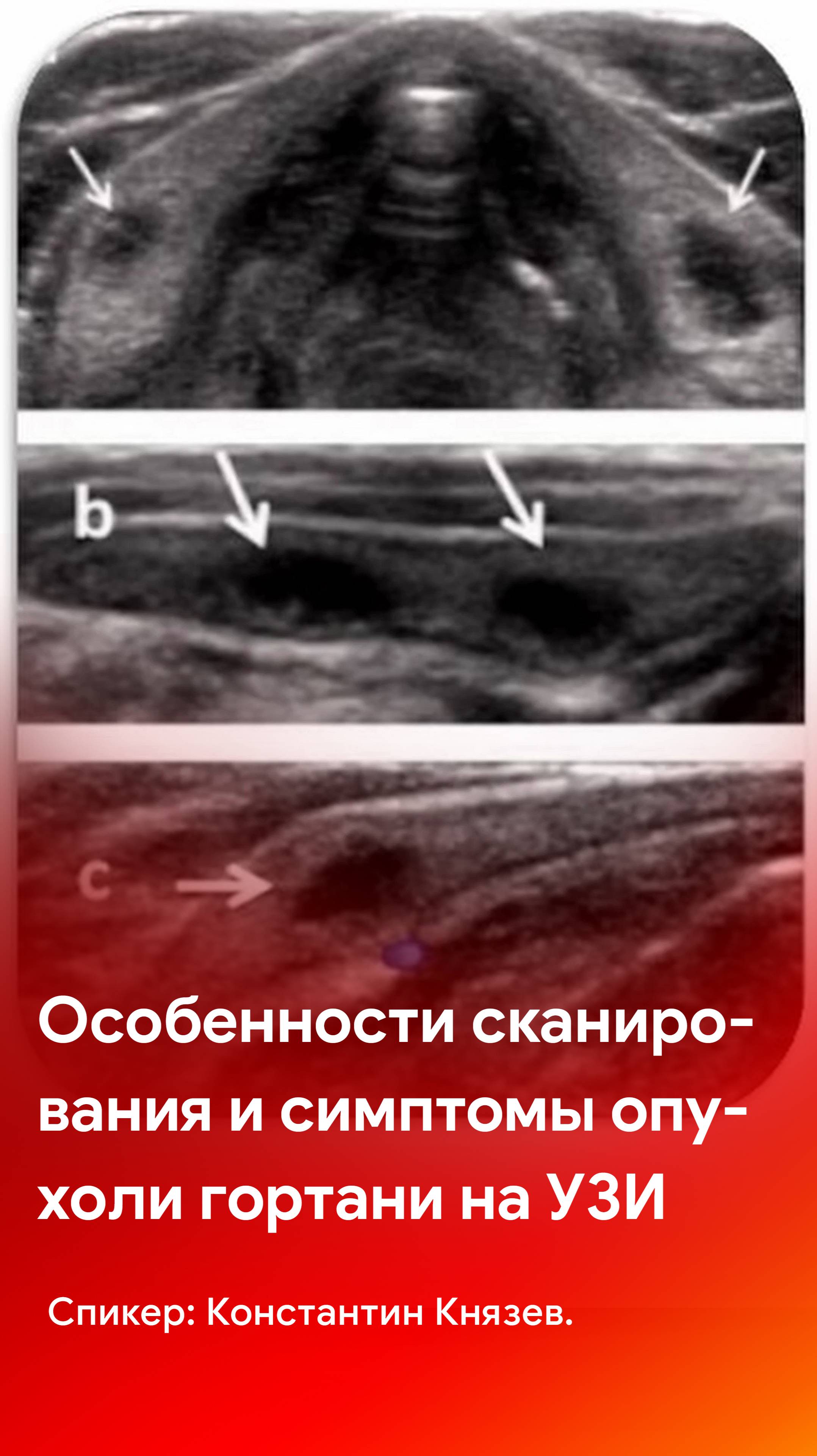 Особенности сканирования и симптомы опухоли гортани на УЗИ