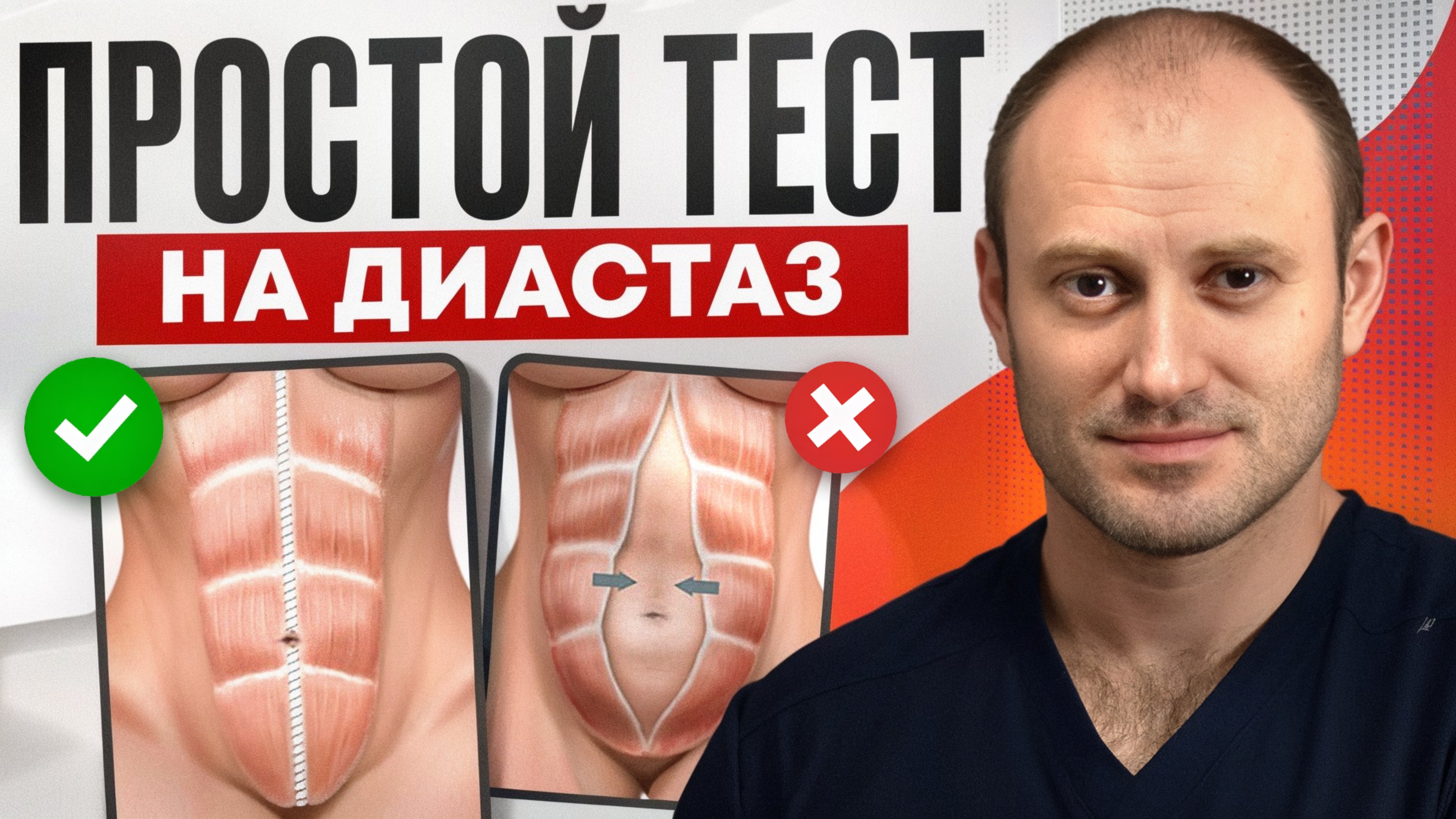 ПРОСТОЙ СПОСОБ проверить себя на диастаз / Когда необходима операция?
