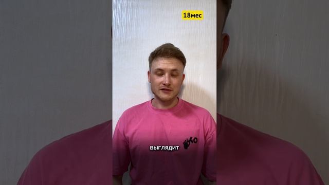 Пересадка волос в Турции. Часть-21(18-ый месяц после опер