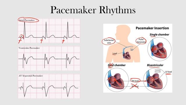 66.Pacemaker Rhythms