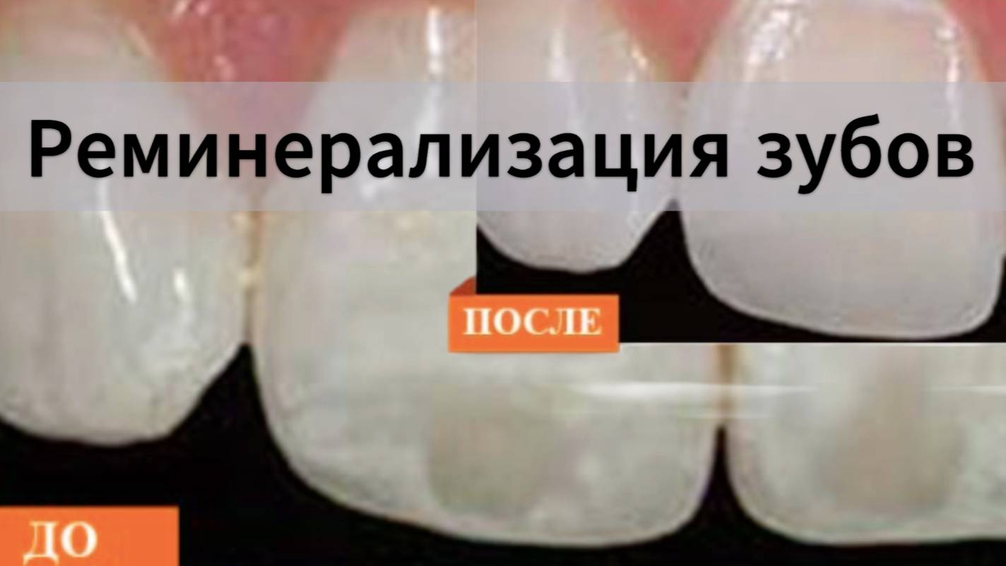 🛠 Реминерализация зубов