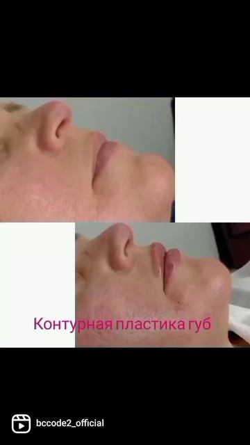 Акция губы|Москва