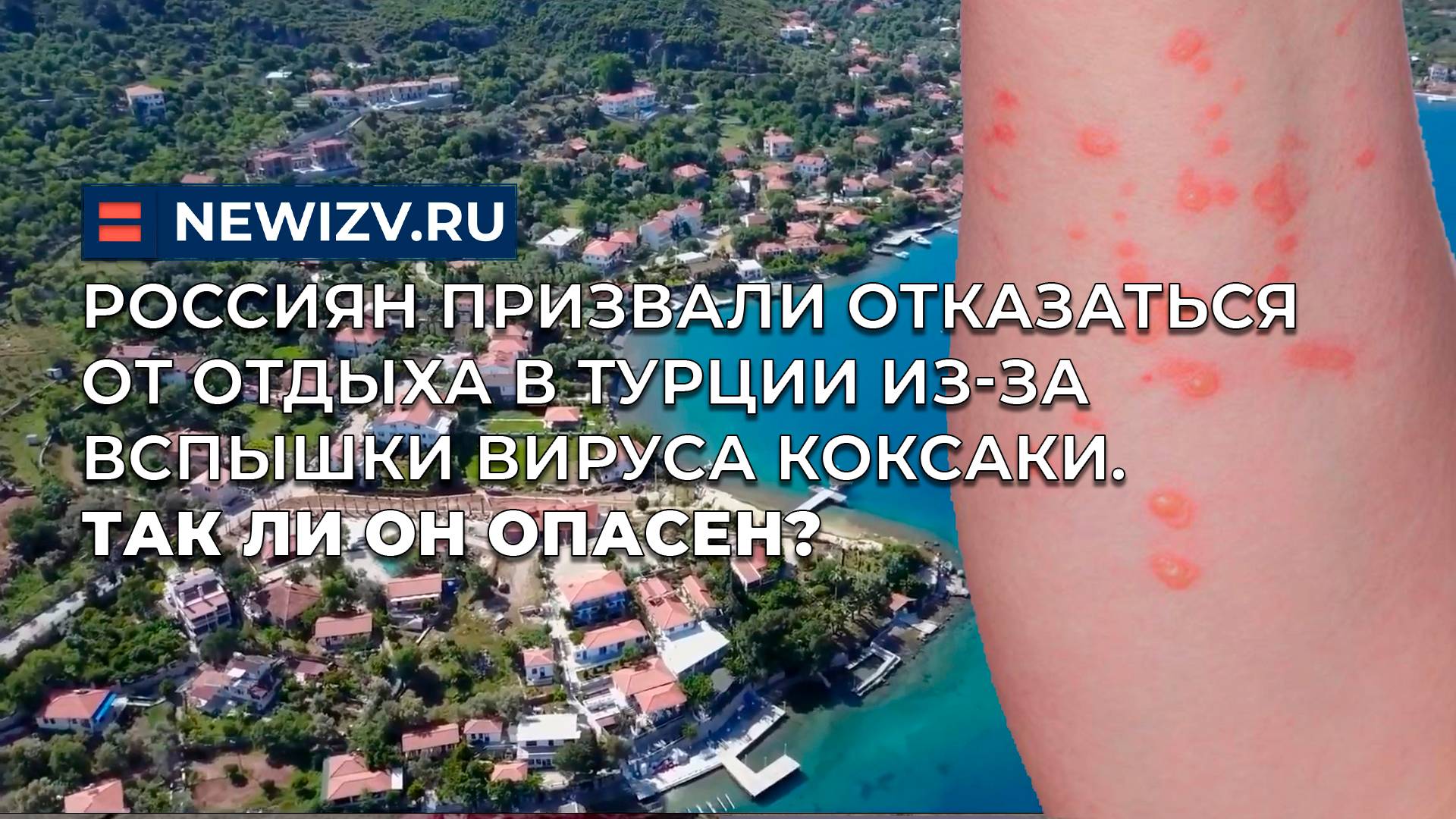Россиян призвали отказаться от отдыха в Турции из-за вспышки вируса Коксаки. Так ли он опасен?