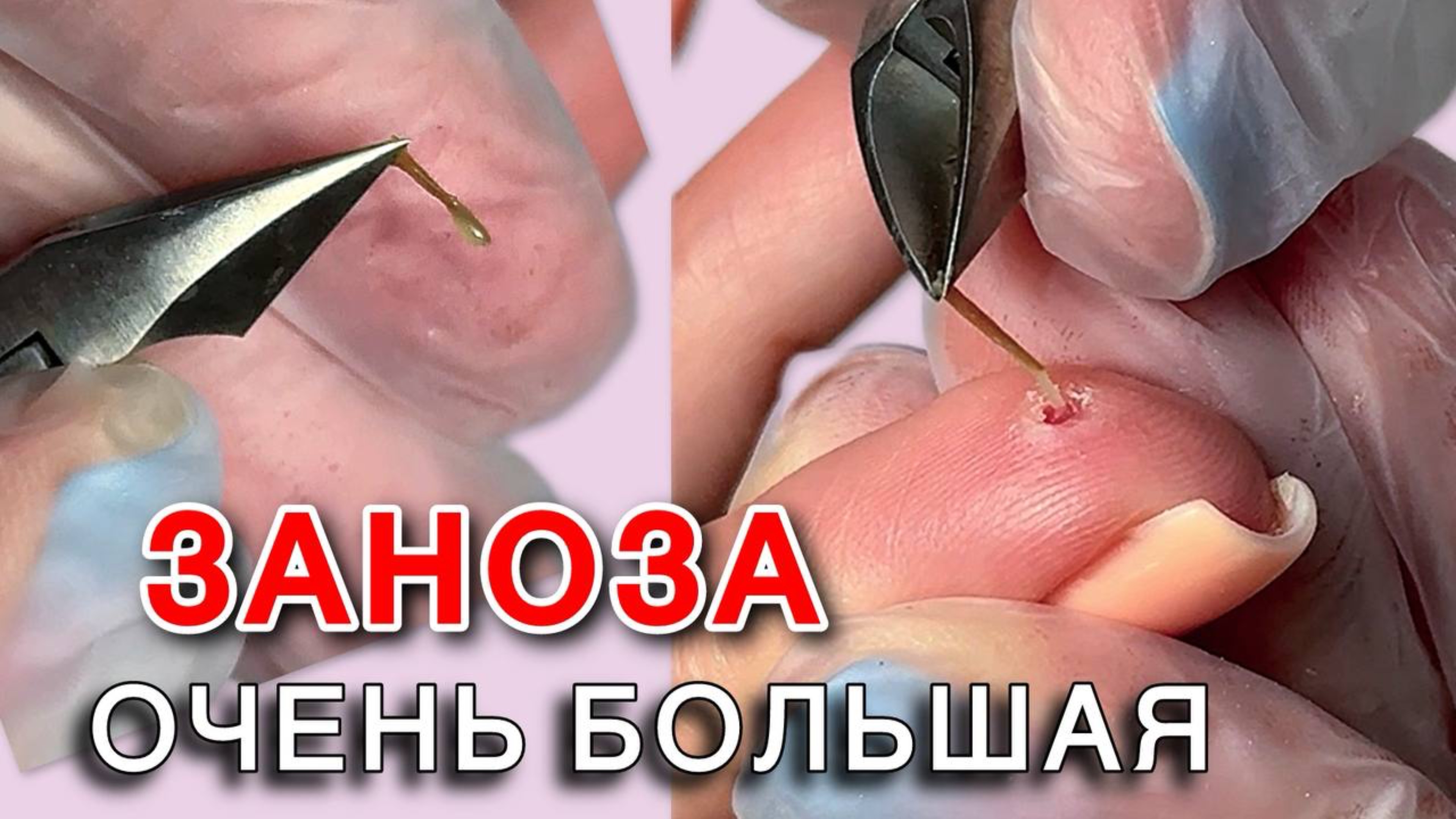 Заноза