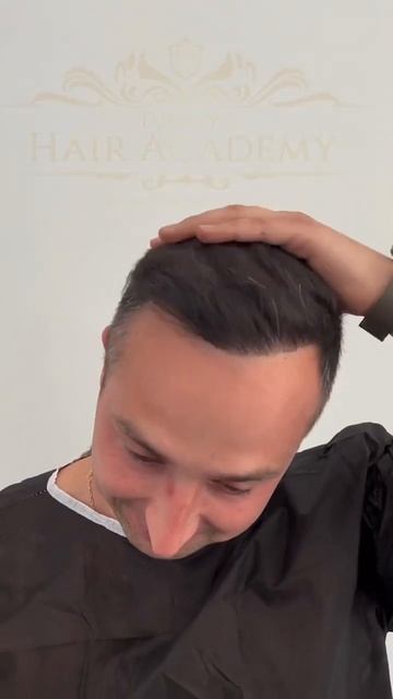 Результаты пересадки волос в нашей клинике🔥