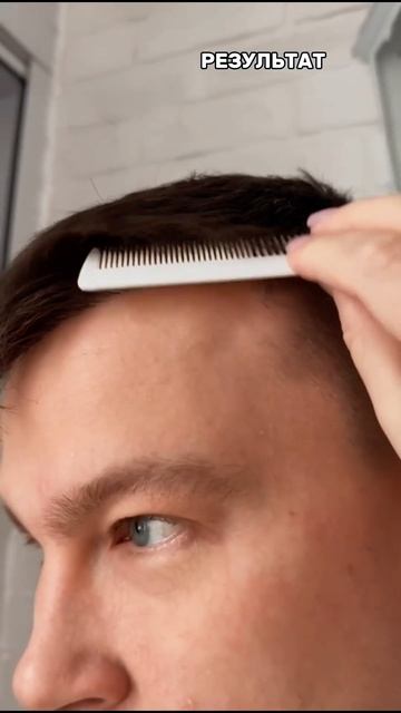 3500 ГРАФТОВ. ДО И ПОСЛЕ ПЕРЕСАДКИ ВОЛОС #hairtransplantion