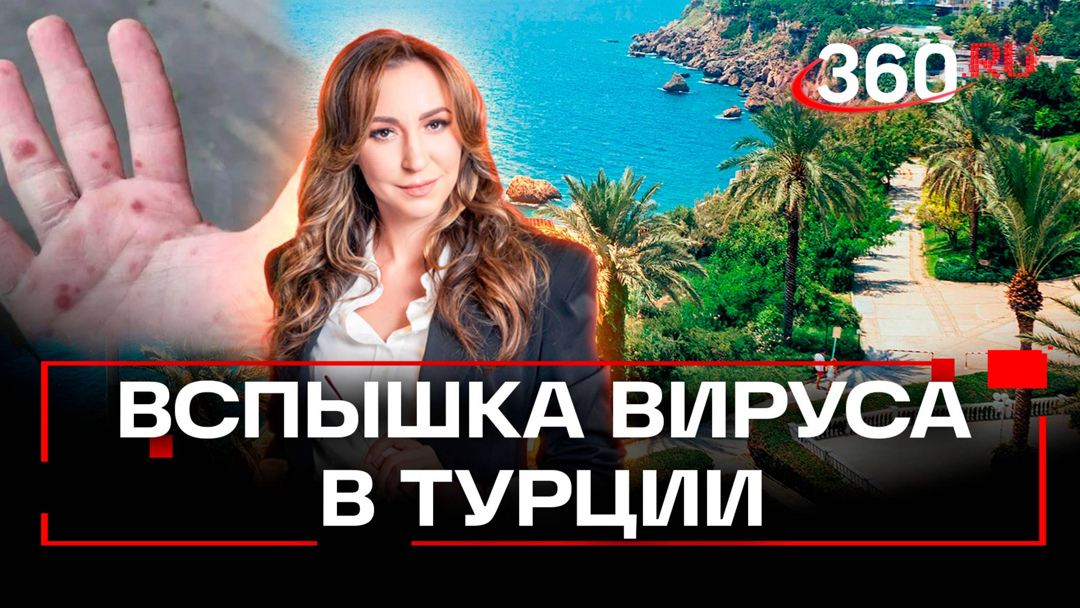 Вирус коксаки на Шри-Ланке и в Турции