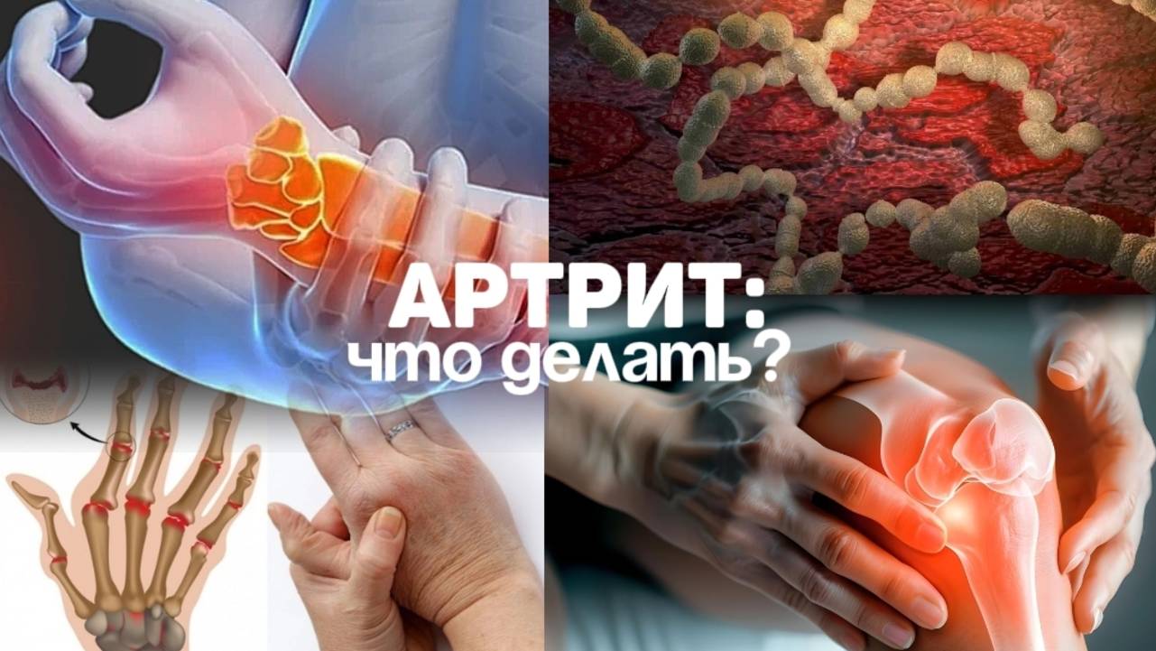 АРТРИТ: ЧТО ДЕЛАТЬ? Семейный доктор Алена Братишко