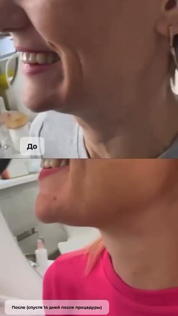 Услуги косметолога в студии КэТ! Результат клиентки до и после процедур!