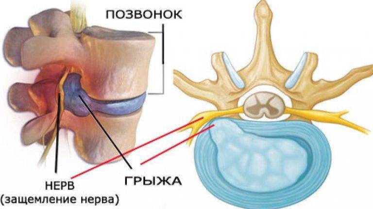 боли в пояснице