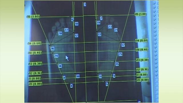 3D моделирование и изготовление ортопедических стелек