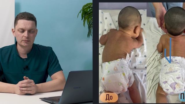 Тейпирование при асимметрии корпуса у детей до года