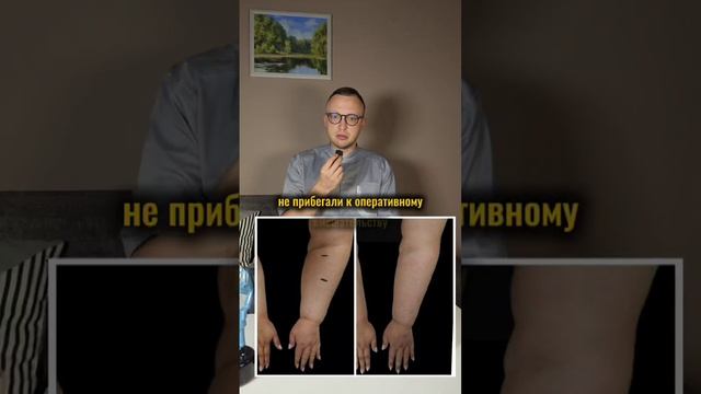 лимфостаз после операции