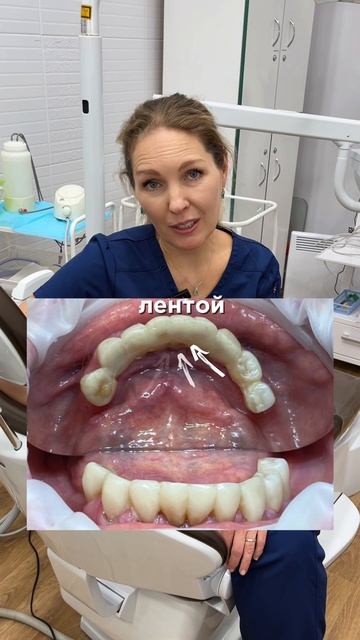 🦷Эстетическое шинирование зубов в "Персона Дент" ✨🦷
