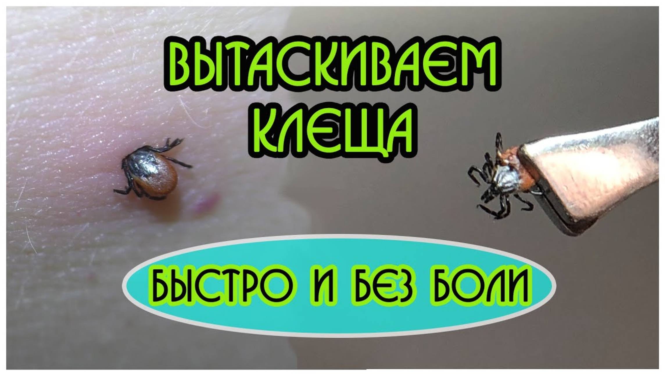 Как быстро вытащить клеща у человека правильно — первая помощь при укусе клеща