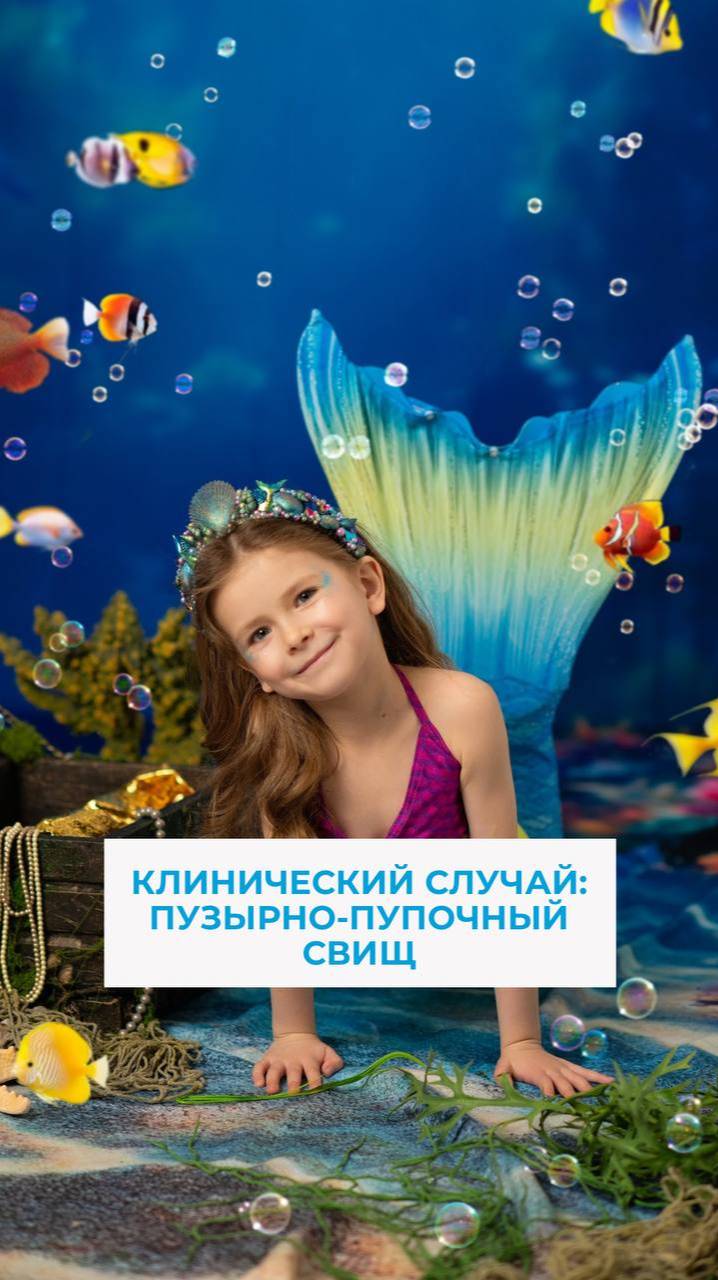 Незаращение урахуса